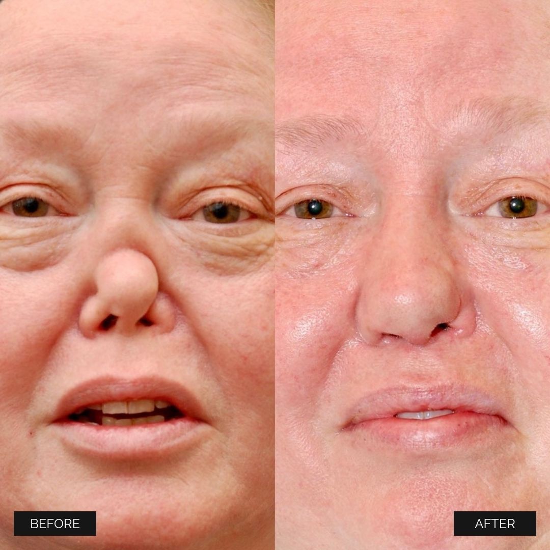 Reconstruction Before & After