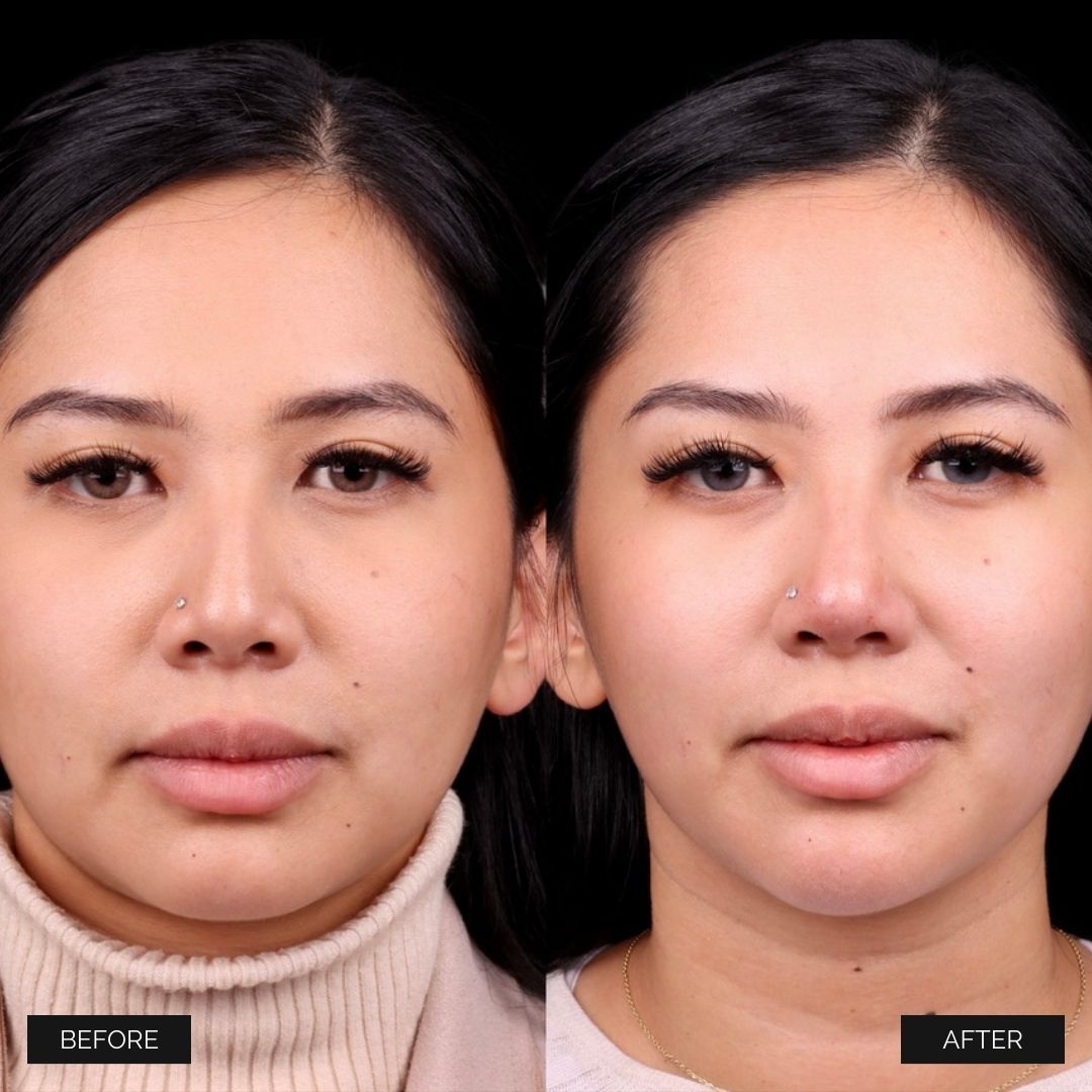 Liquid Rhinoplasty Before & After
