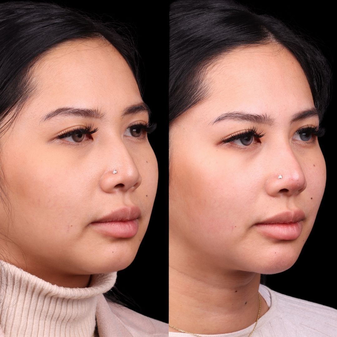 Liquid Rhinoplasty Before & After