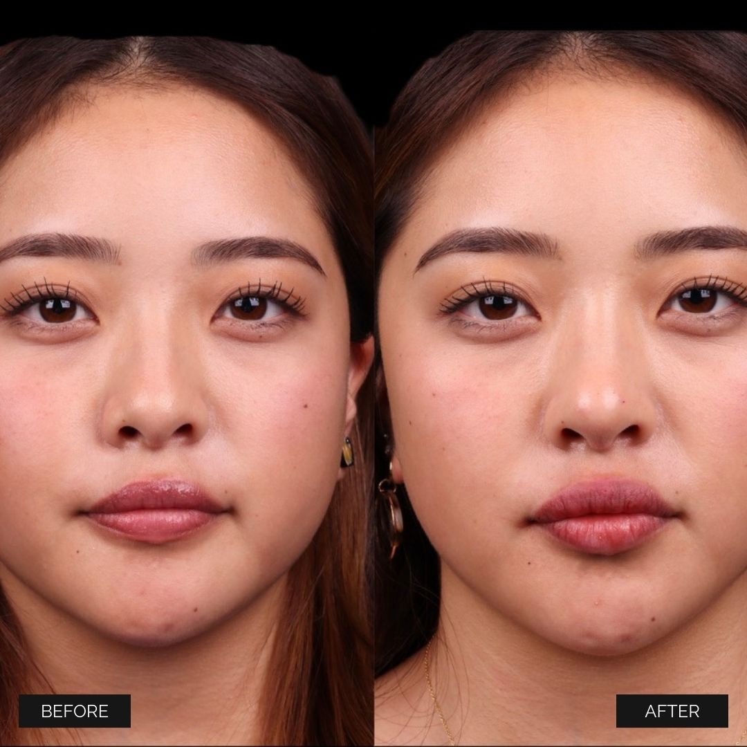 Liquid Rhinoplasty Before & After