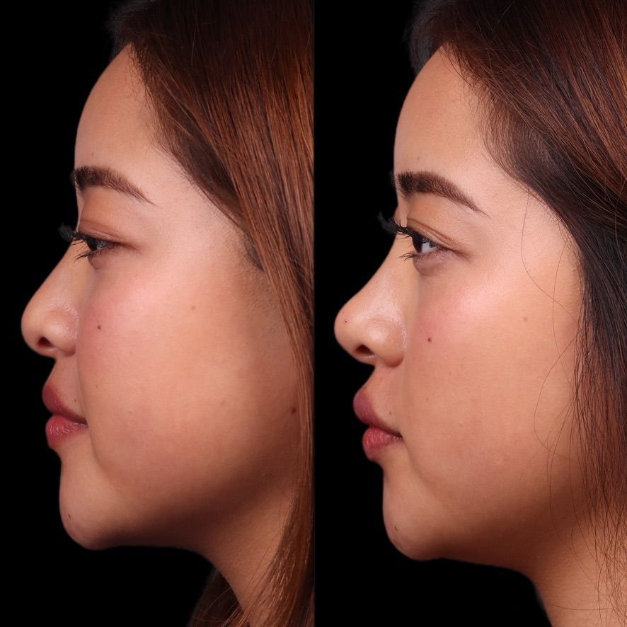 Liquid Rhinoplasty Before & After