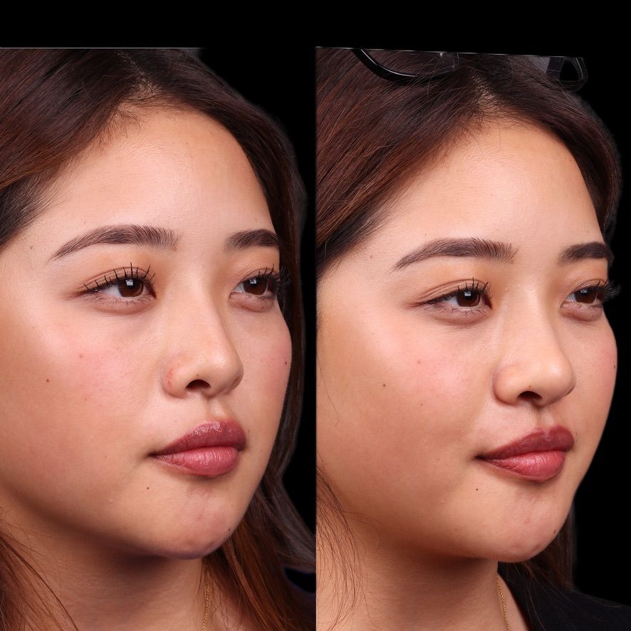 Liquid Rhinoplasty Before & After