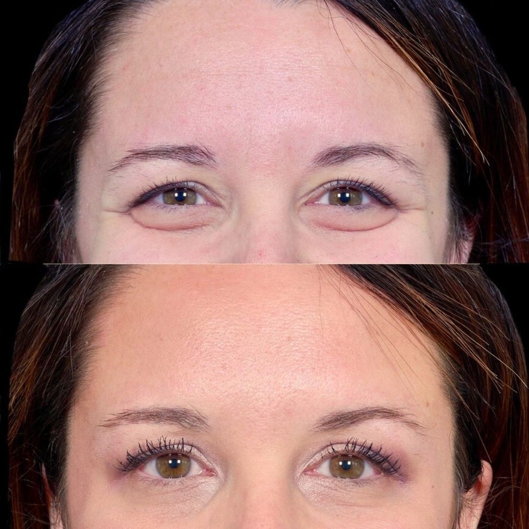 Facial Injectables & Fillers  Before & After