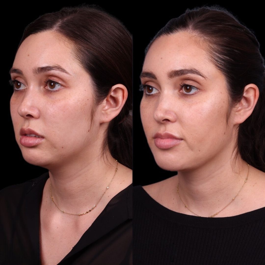 Facial Injectables & Fillers  Before & After