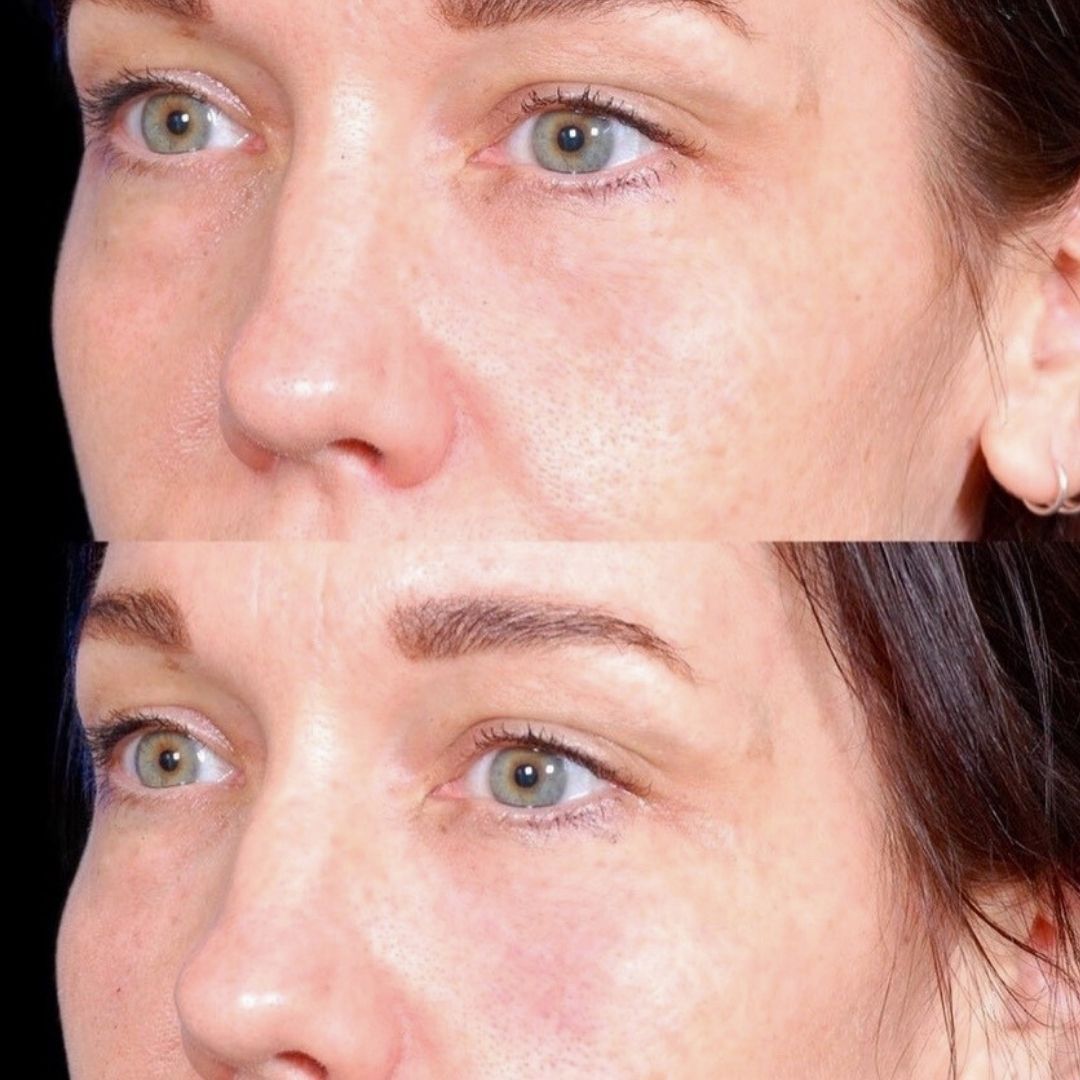Facial Injectables & Fillers  Before & After