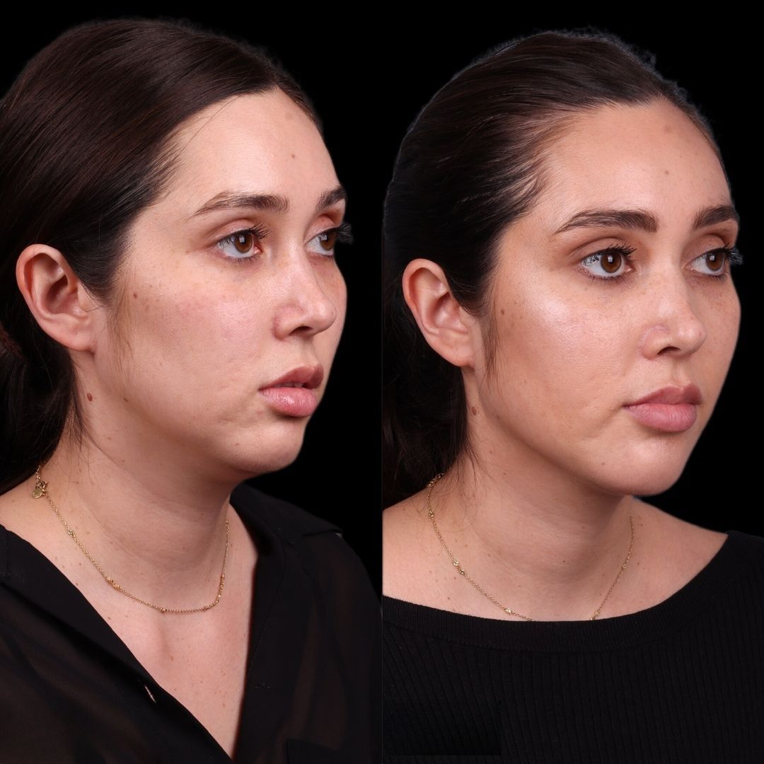 Facial Injectables & Fillers  Before & After