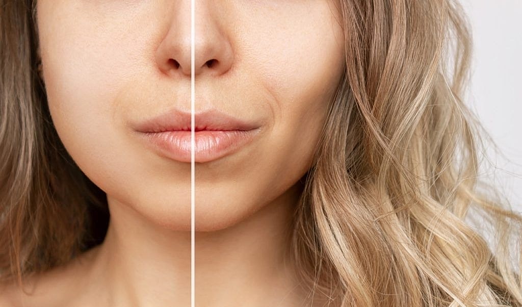 Sculpt Your Face with Buccal Fat Removal by Dr. Dunn in Newport Beach